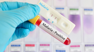 Ilustrasi pemeriksaan malaria. Foto: Canva