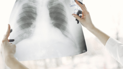 Ilustrasi TBC. Foto: Canva